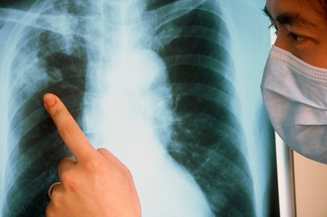 "Горячая линия" по профилактике туберкулеза
